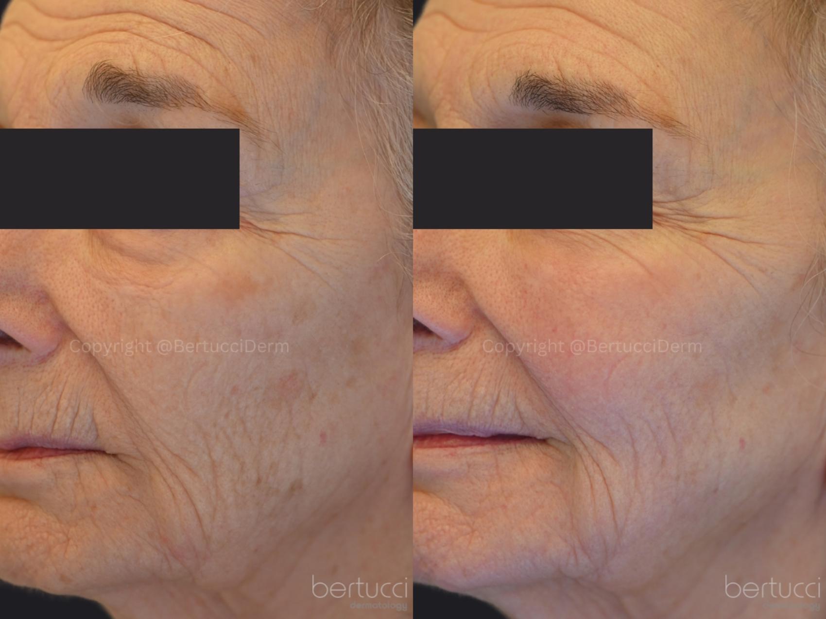 Before & After Fraxel® Case 11 Left Oblique View in Woodbridge, Ontario