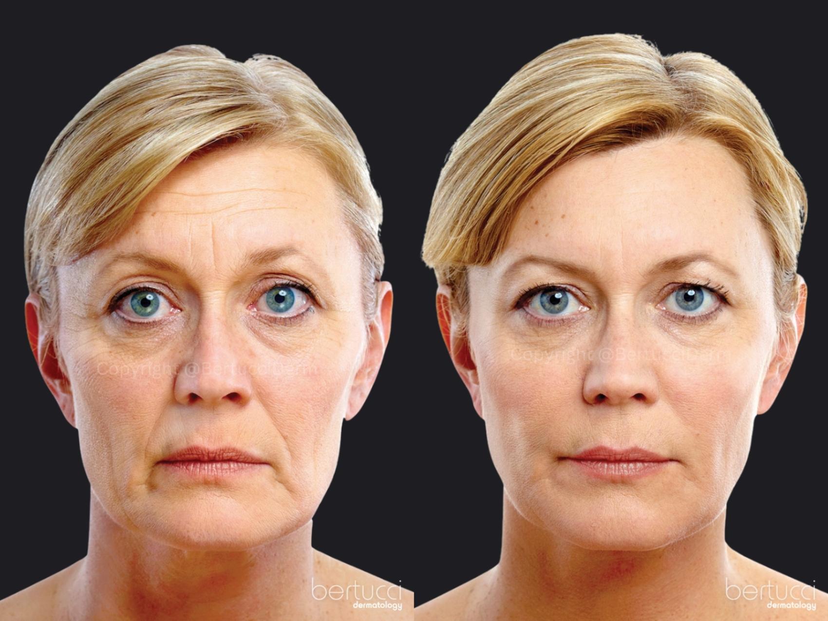 Before & After BOTOX® Cosmetic & Other Neuromodulators Case 17 Front View in Woodbridge, Ontario