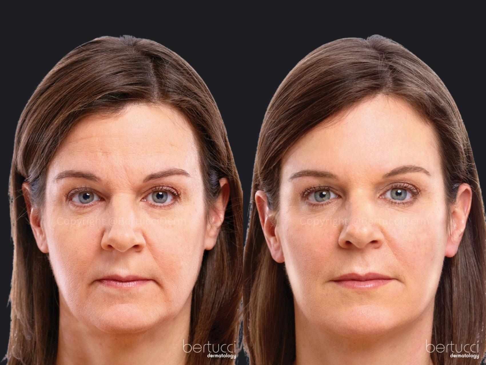 Before & After BOTOX® Cosmetic & Other Neuromodulators Case 19 Front View in Woodbridge, Ontario