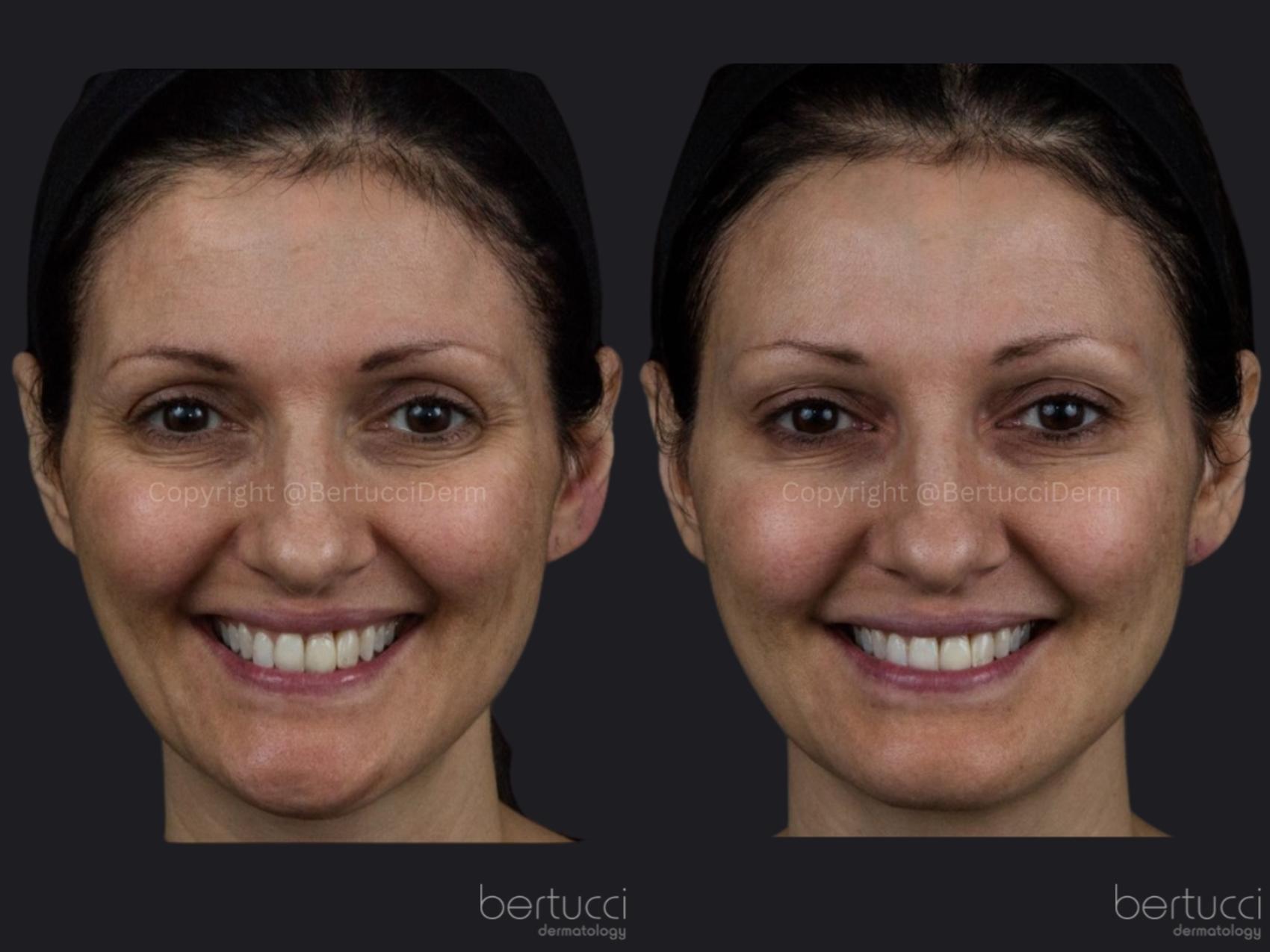 Before & After BOTOX® Cosmetic & Other Neuromodulators Case 16 Front View in Woodbridge, Ontario