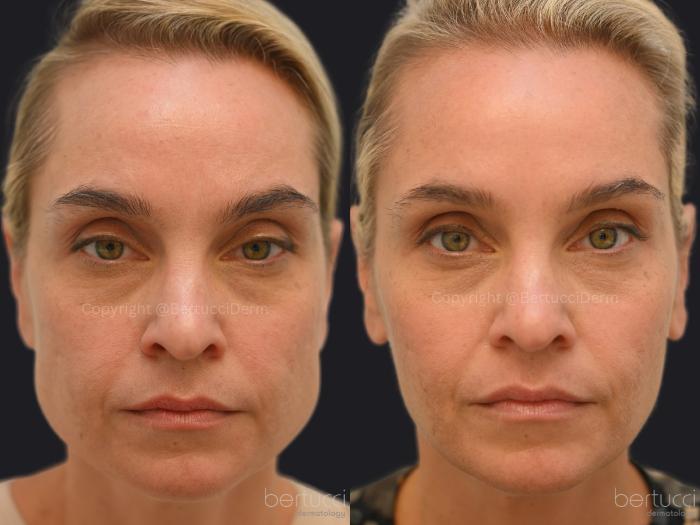 Before & After BOTOX® Cosmetic & Other Neuromodulators Case 6 Front View in Woodbridge, Ontario