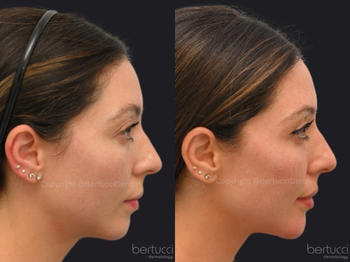 Before & After Dermal Fillers Case 10 Right Side View in Woodbridge, Ontario