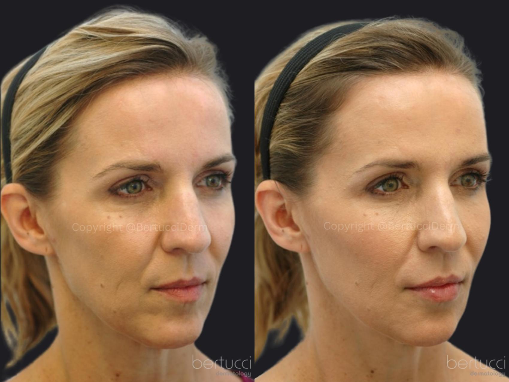 Before & After Dermal Fillers Case 12 Right Oblique View in Woodbridge, Ontario