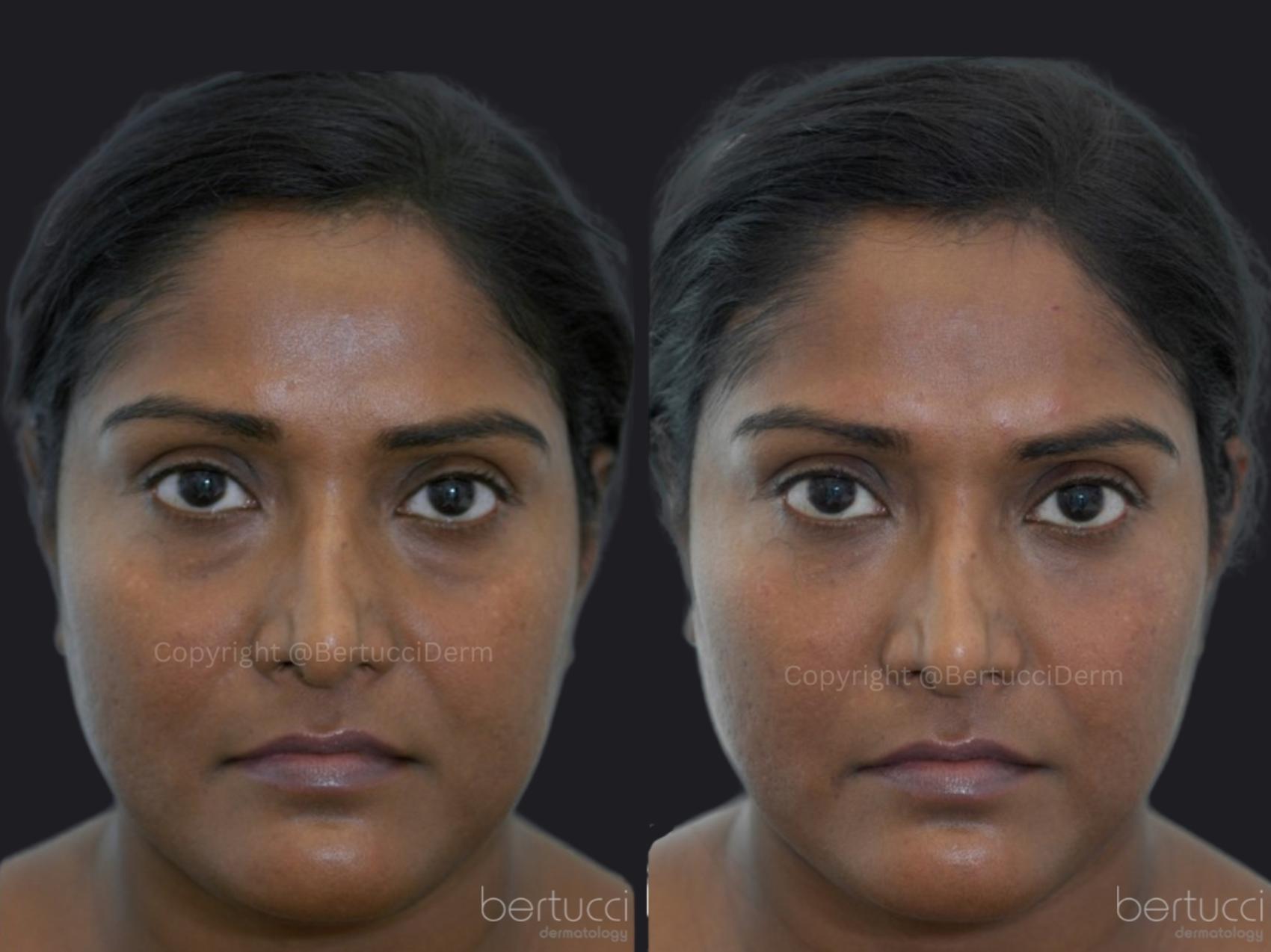 Before & After Dermal Fillers Case 15 Front View in Woodbridge, Ontario