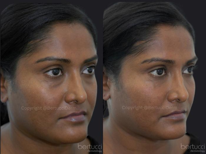Before & After Dermal Fillers Case 15 Right Oblique View in Woodbridge, Ontario