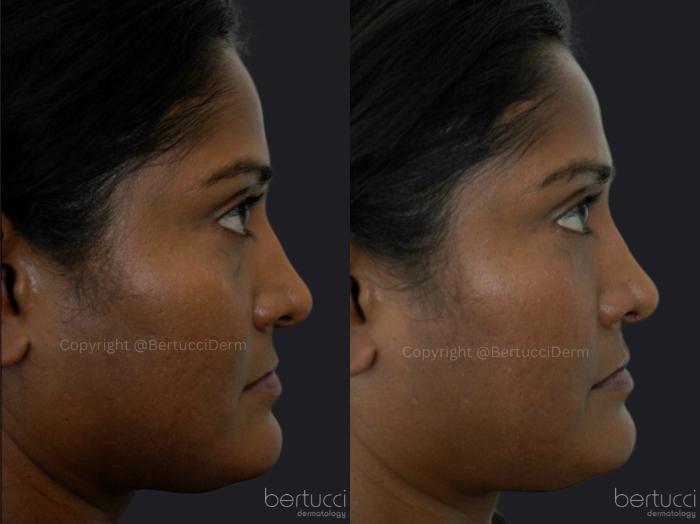 Before & After Dermal Fillers Case 15 Right Side View in Woodbridge, Ontario