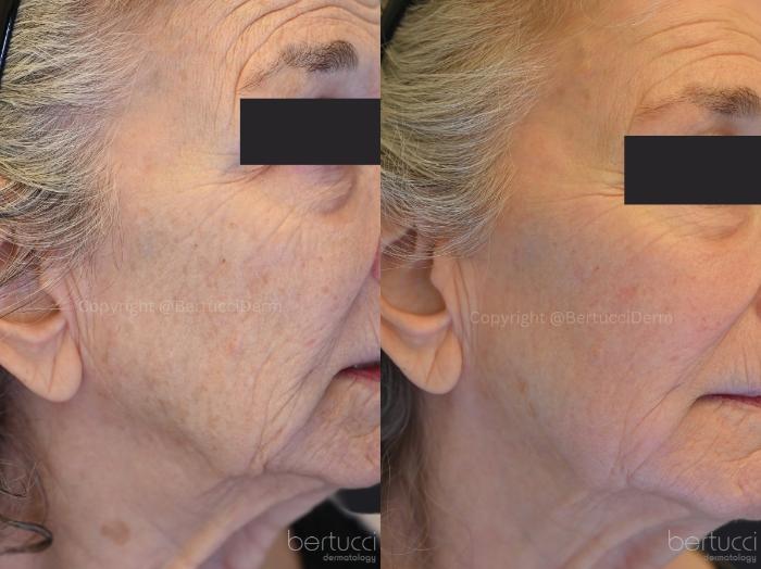 Before & After Fraxel® Case 11 Right Oblique View in Woodbridge, Ontario