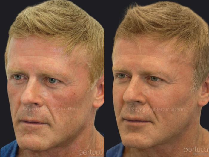 Before & After Full Face Rejuvenation Case 14 Left Oblique View in Woodbridge, Ontario