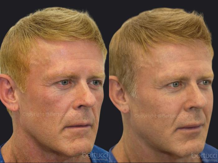 Before & After Full Face Rejuvenation Case 14 Right Oblique View in Woodbridge, Ontario