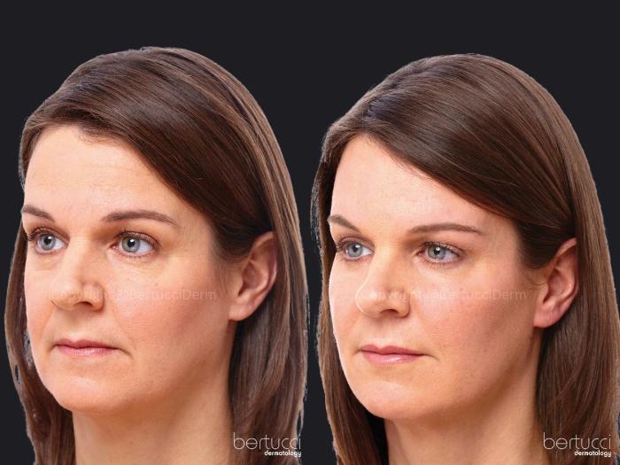 Before & After BOTOX® Cosmetic & Other Neuromodulators Case 19 Left Side View in Woodbridge, Ontario