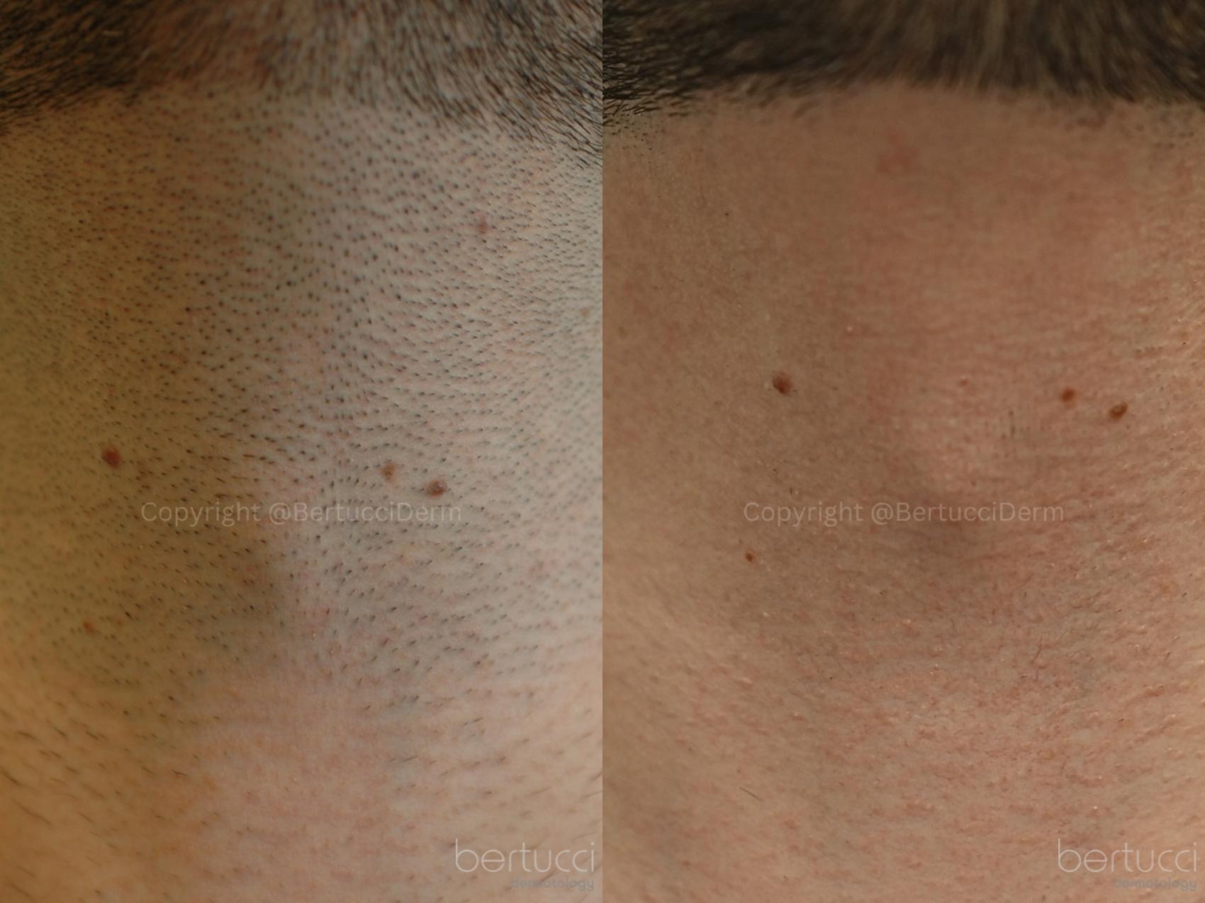 Before & After Laser Hair Removal Case 9 Front View in Woodbridge, Ontario