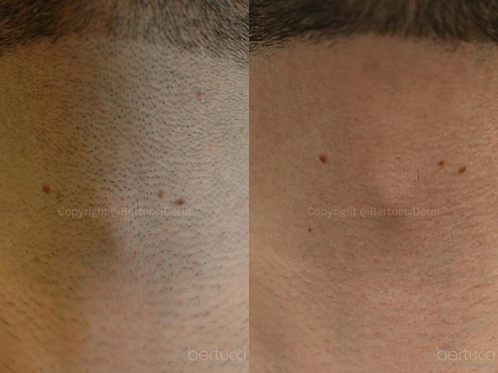 Before & After Laser Hair Removal Case 9 Front View in Woodbridge, Ontario